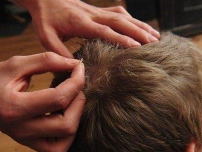 شپشزدگی از چالش اجتماعی تا راهکار بهداشتی