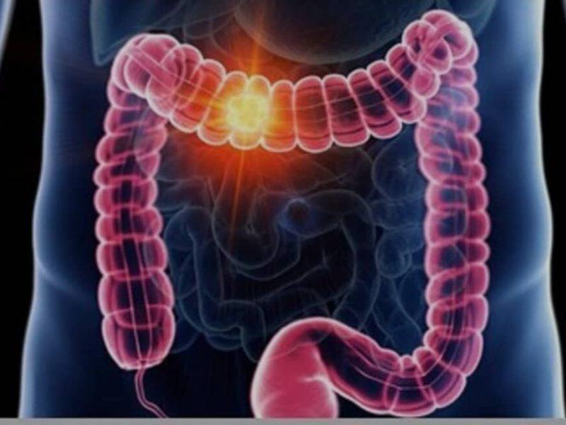 علائم گوارشی را ساده نگیرید؛ هر خونریزی هموروئید نیست