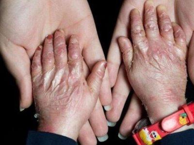شناسایی ۱۲۵۰ بیمار پروانهای/ تحریم هستیم، اما به قدر کافی پانسمان داریم