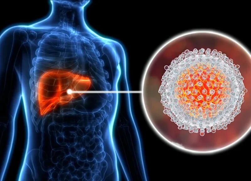 از رفتارهای پرخطر تا سیروز کبدی؛ هپاتیت را پیش از غافلگیری مهار کنیم